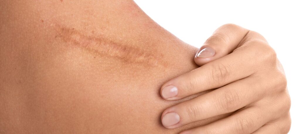 littekens behandelen