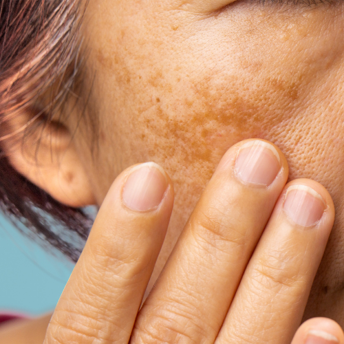 Medical-Cosmetics-Melasma-Pigment