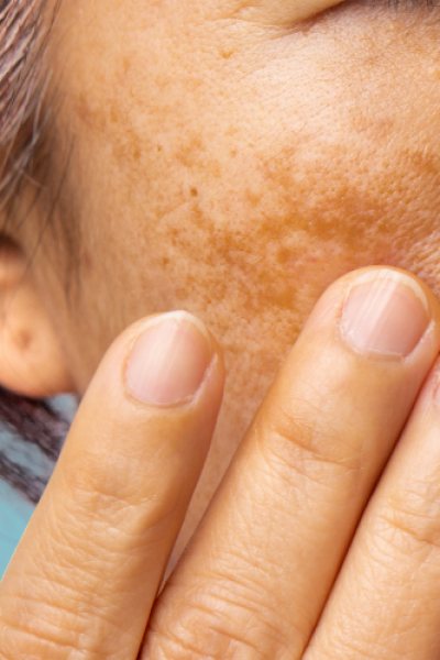Medical-Cosmetics-melasma-Pigment Medical-Cosmetics-Melasma-Pigment
